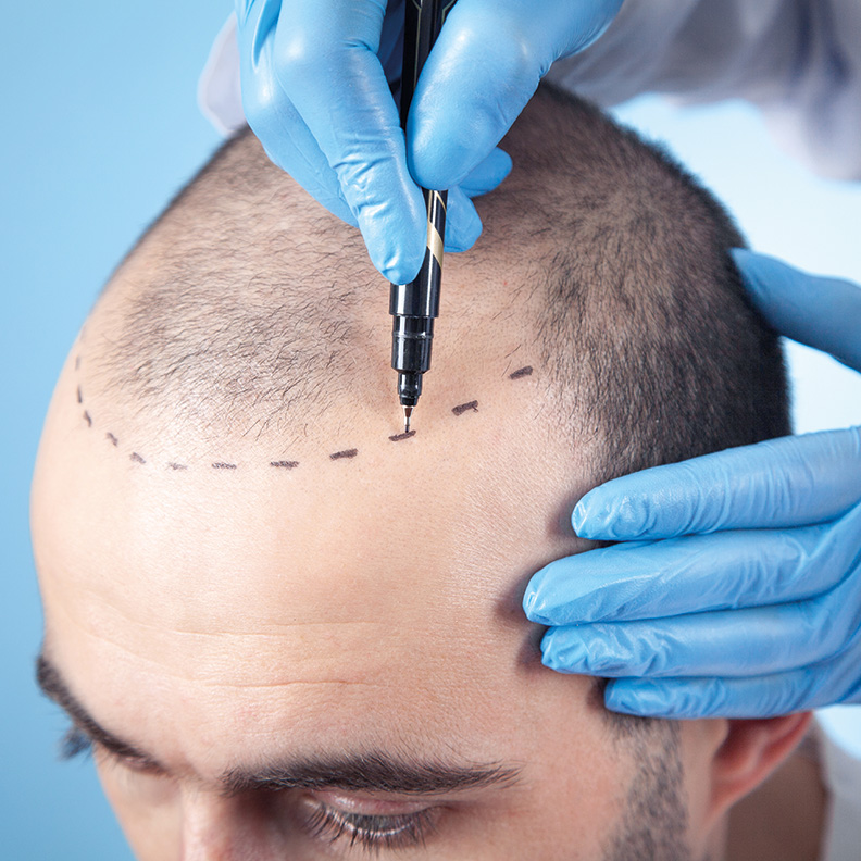 hair-transplant-aftercare-guide-correct-nutrition-and-healing-process